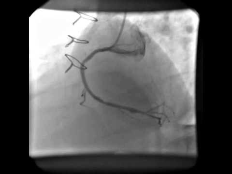 стеноз общей сонной артерии. стентирование сосудов сердца после инфаркта. шунтирование аорты сердца. коронарография при инфаркте. мрт стентирование можно.