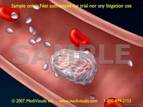 Clot Formation and Clot Breakdown: 2D Medical Animation - YouTube