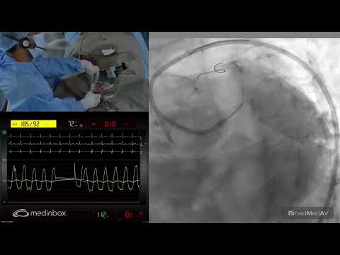 PCI To Ostial LM Using IVL