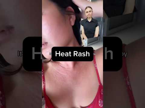 Beat Heat Rash Fast With These Simple Home Solutions