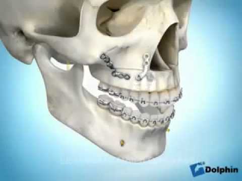 Complesso alla osteocondrosi cervicale toracica Trattamento Volzhsky di ernia spinale
