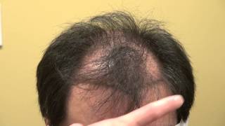 preview picture of video 'Frontal Bald Hair Loss Restoration Surgery Los Gatos Near San Jose CA Dr. Diep www.mhtaclinic.com'