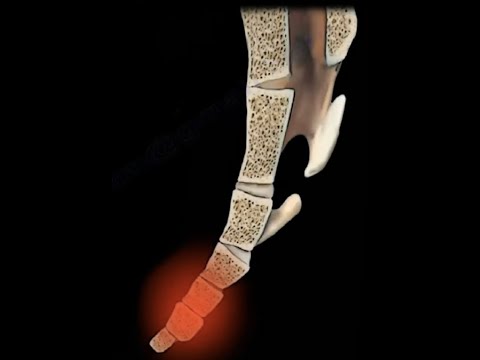 Tailbone pain /coccydynia , coccyx