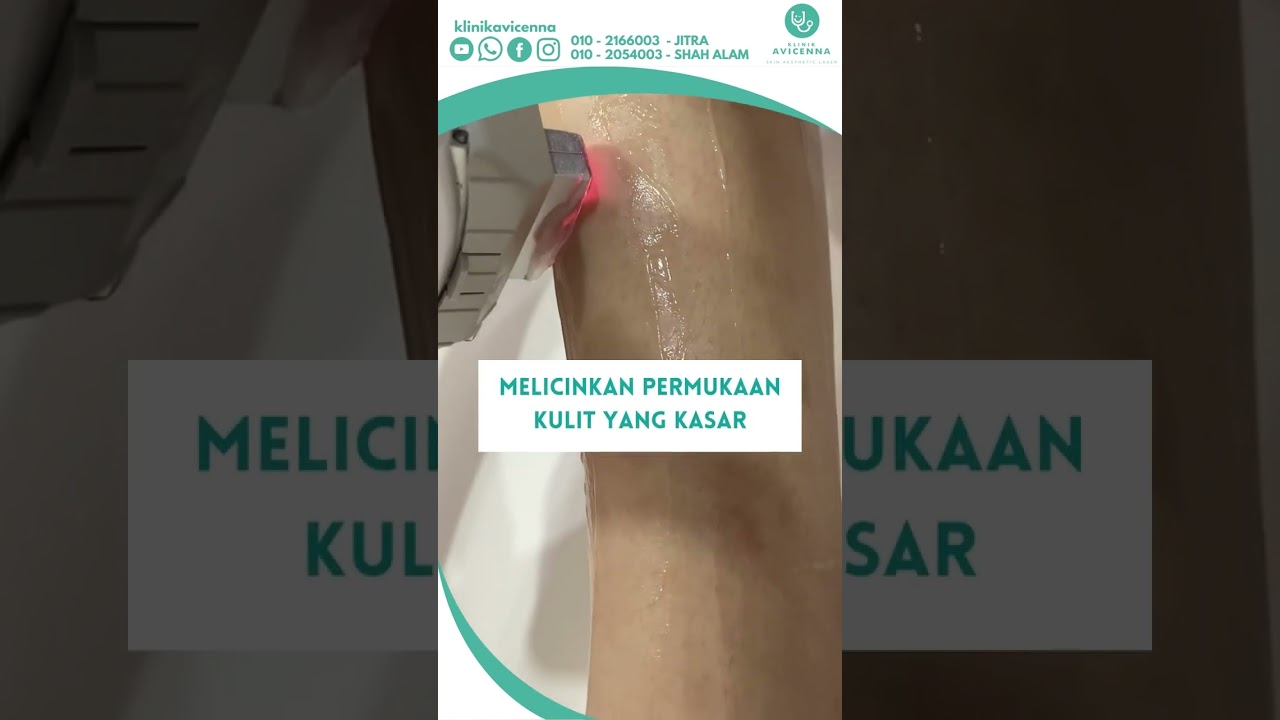 Subcision : Rawatan Acne Scar