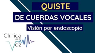 Quiste en las cuerdas vocales