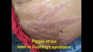 PURPLE STRIAE - CUSHING