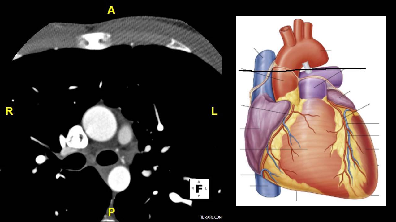 Axial CT Heart