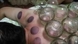 Traditional Chinese Medicine TCM Cupping Schröpfe