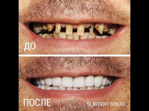 Накладные виниры, виниры на зубы отзывы, как поставить виниры
