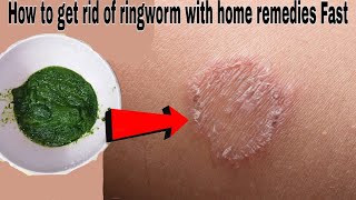 How to get rid of ringworm with home remedies Fast, Ringworm treatment How to itch will get rid