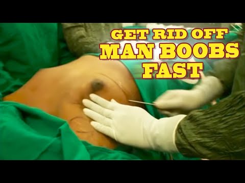 Know about the Gynecomastia Surgery In Mumbai | Watch Live Video of Gynecomastia Surgery By Dr Sagar