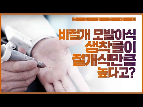 비절개 모발이식의 생착률이 절개식만큼 높다고? 초음파 비절개 모발이식의 원리와 과정.