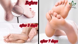 How To Treat Cracked Heels? How To Cure Dry Rough Cracked Or Split Painful Heels