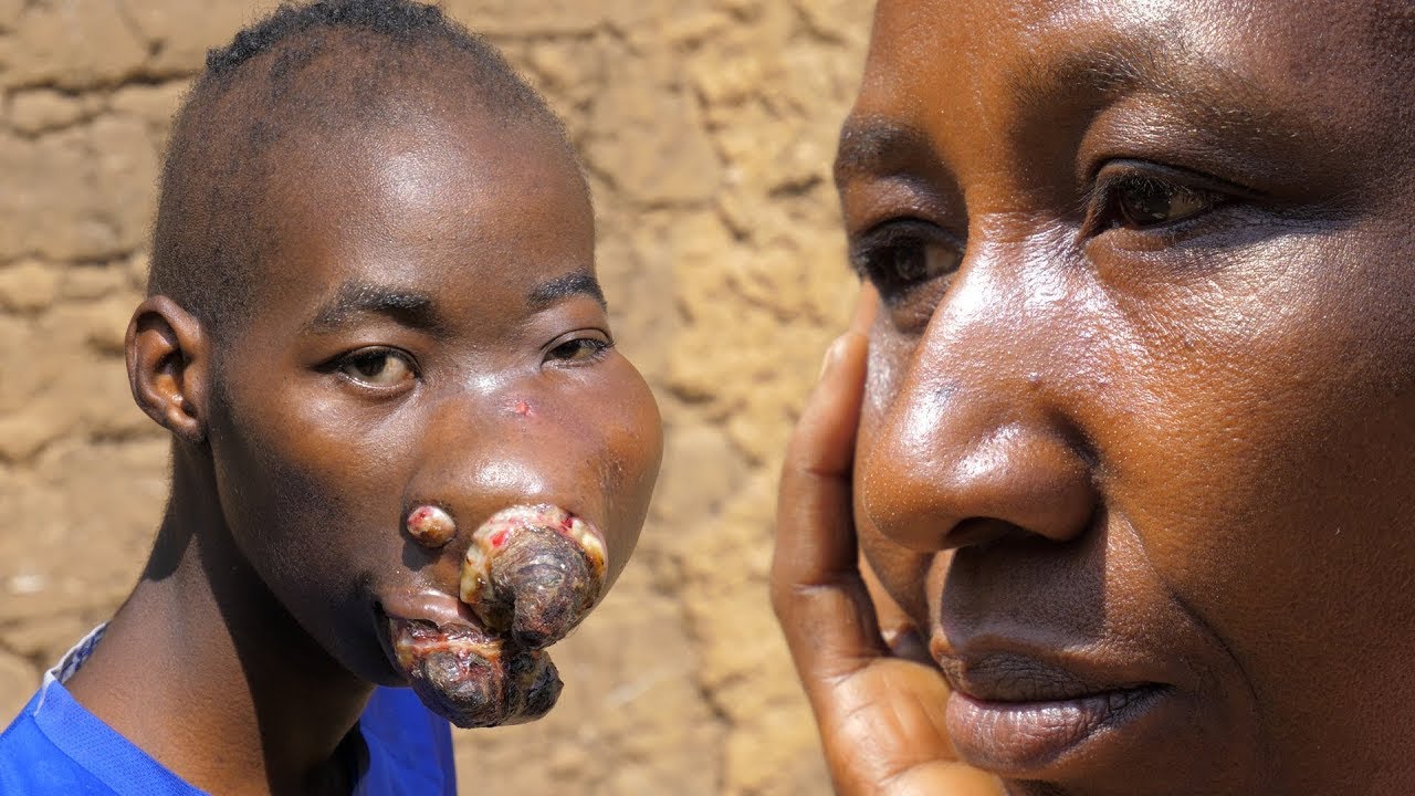 IMPOSSIBLE A REGARDER, DES ASTICOTS SORTENT DE LA BOUCHE DE CET ENFANT