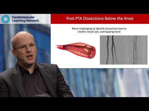 Critical Limb Ischemia: Best Practices for Addressing Calcification
