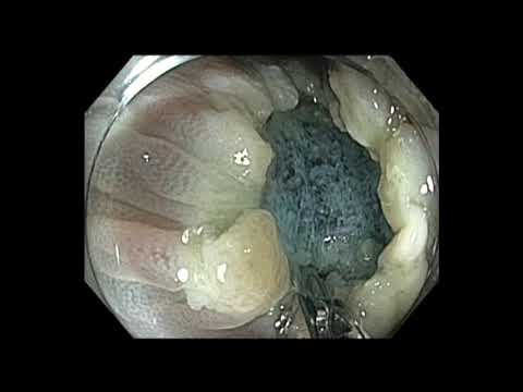 Colonoscopy: Transverse Colon Polyp Resection