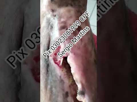 Acidentado de moto, aguardava havia 25 anos para fazer uma cirurgia (só click no play se desejar ver) imagens fortes