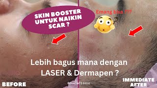 Download lagu Skin Booster Before After untuk Bopeng Bekas Jerawat - Ovela Clinic Jakarta mp3 Download lagu Skin Booster Before After untuk Bopeng Bekas Jerawat - Ovela Clinic Jakarta mp3
