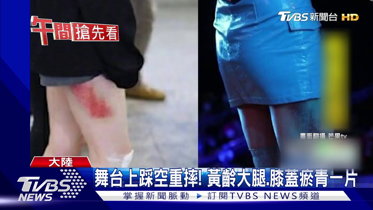 恐怖！黃齡踩空摔下舞台　整腿黑青照唱