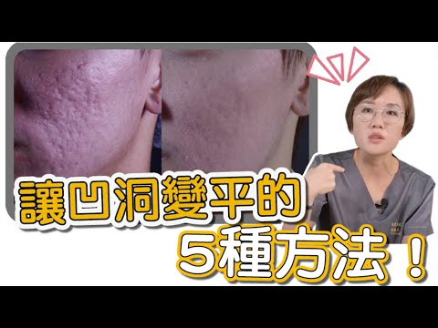 額頭凹洞
