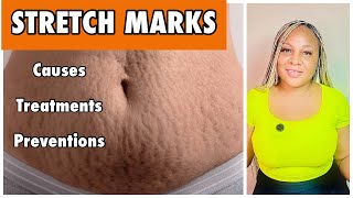 Stretch Marks Remedy | How To Remove Stretch Marks + Causes & Treatments