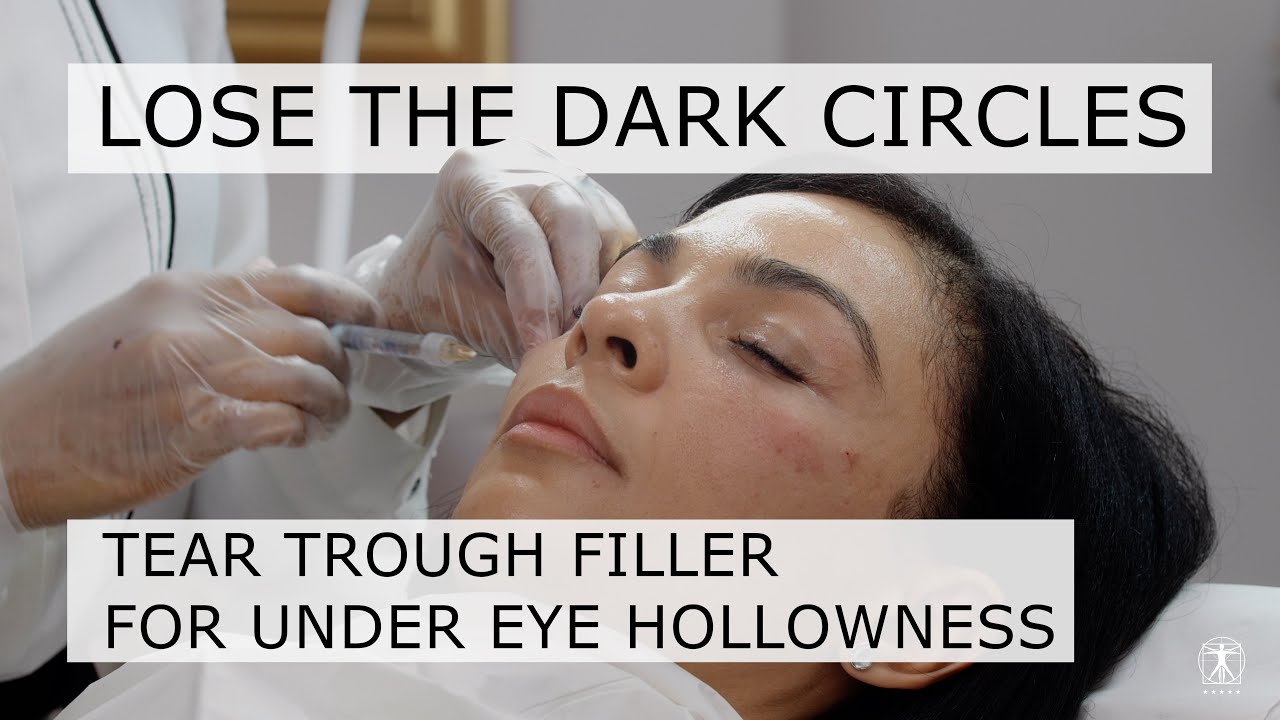 Tear Trough Filler for Under Eye Hollowness | Lose the Dark Circles