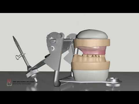 Totalprothese Köln - Herstellung Ablauf