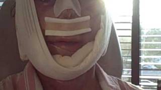 My Facial Plastic Surgery Blog – Recovery Day 2