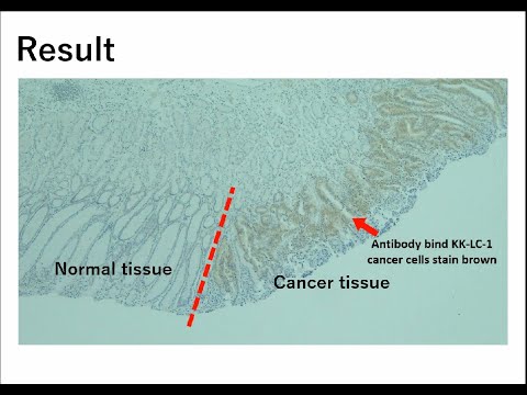Toward Early Detection of Cancer