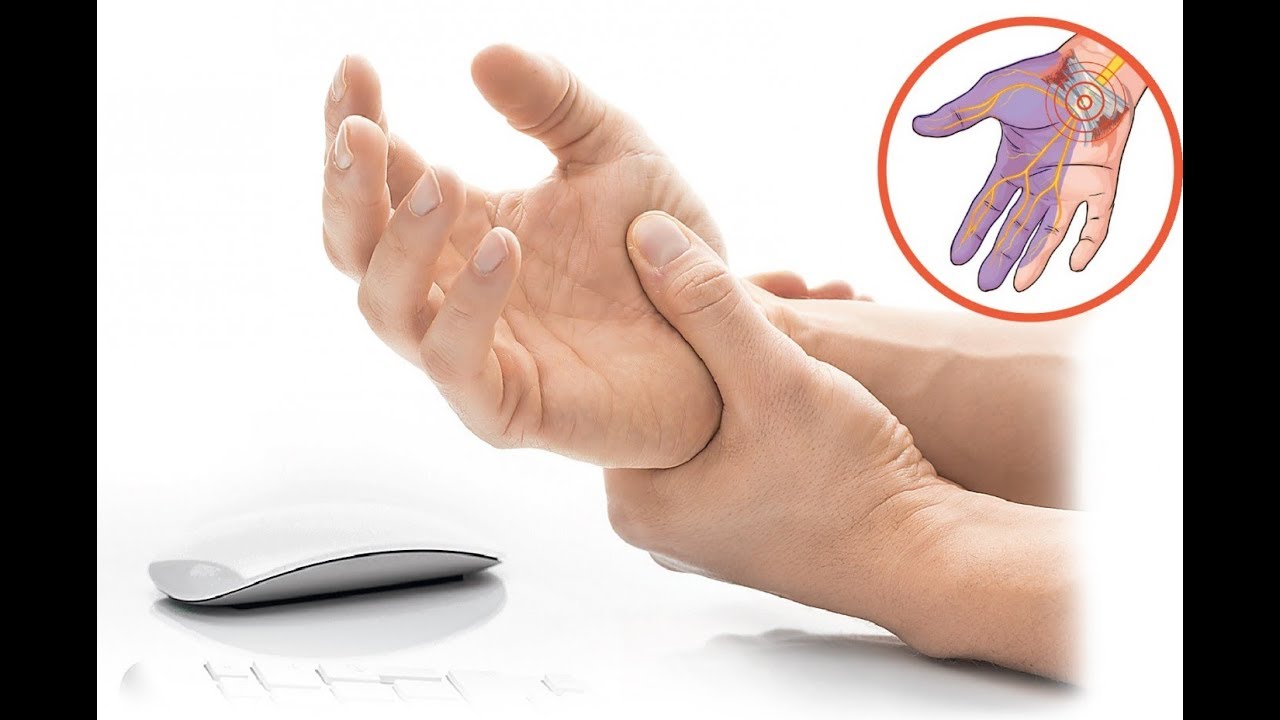 Синдром карпального канала - причины, последствия и лечение