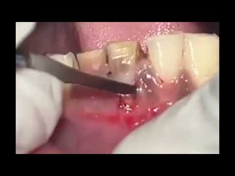 Julldent Micro Blade