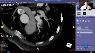 Algorithm for Cardiac CTs 5 Steps and 3D Basic Anatomy