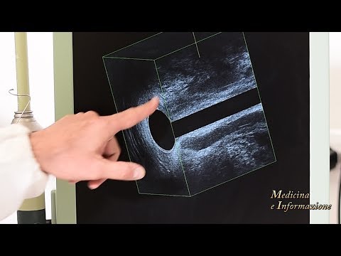 Il video come fare la maggior parte del dito massaggio prostatico Contorni prostatica pari di cosa si tratta