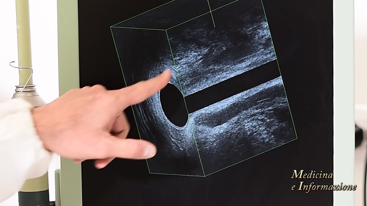 Ascessi e Fistole Anali: le diverse tecniche chirurgiche