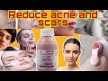 Calamine Lotion For Reduce Acne Or Scars