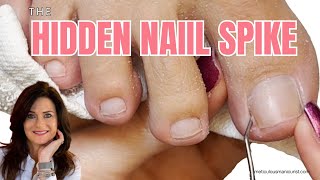 Why Her Toenail Hurt Every Step — the Spike Underneath
