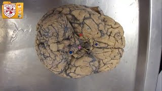 preview picture of video 'Anatomía [Lab] - Irrigación Cerebral - Tintaya'