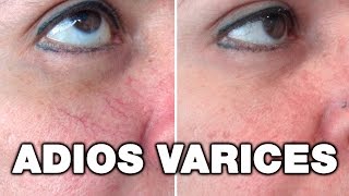 Eliminar Arañas Vasculares en la Cara | Telangiectasias Láser