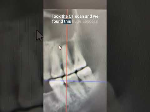 Sinus Broken Through. Not Shown On Regular X Ray #shorts