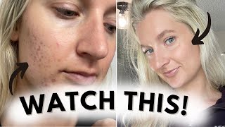 WATCH THIS BEFORE USING TRETINOIN *from cystic hormonal acne to clear skin*