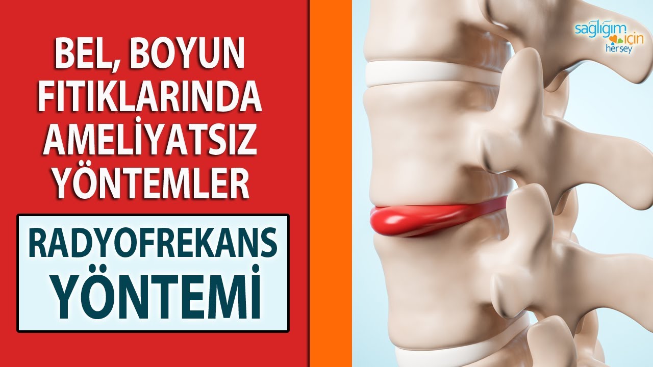 Bel, Boyun Fıtıklarında Ameliyatsız Yöntemler ve Radyofrekans Yöntemi