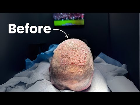 7 Most Common Hair Transplant Regrets