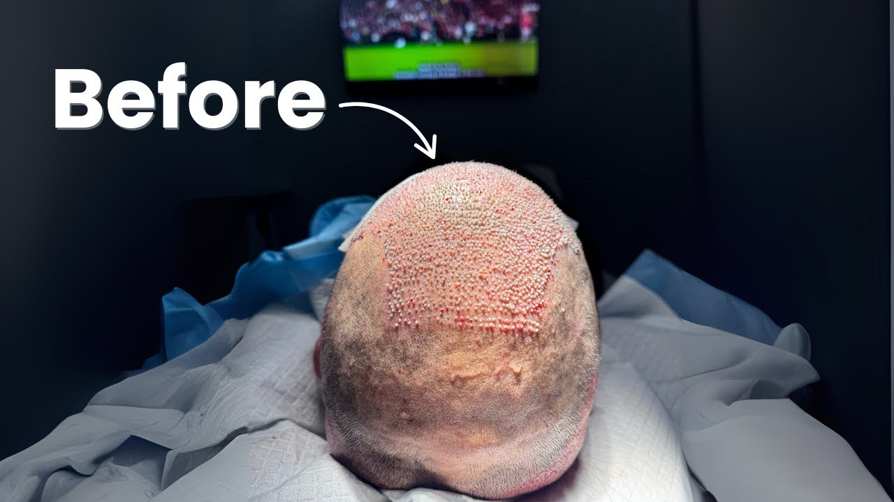 7 Most Common Hair Transplant Regrets