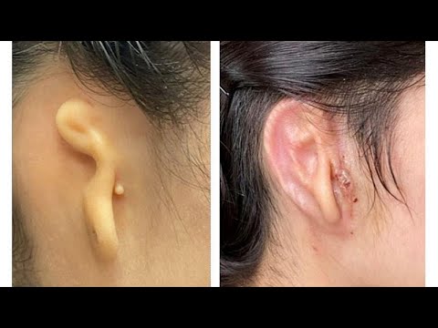 Euronews broadcast covering scientists 3D-bioprinting an ear from human cells and transplanting it into a patient