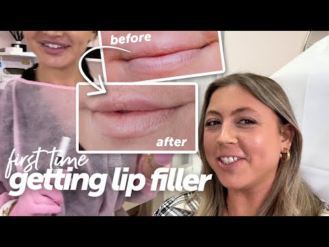 Getting Lip Filler for the FIRST TIME! My experience, Healing process, Before & Afters (+ botox)