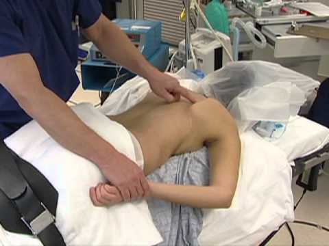 Snapping Scapula | Arthroscopic Treatment for Scapulothoracic Bursitis