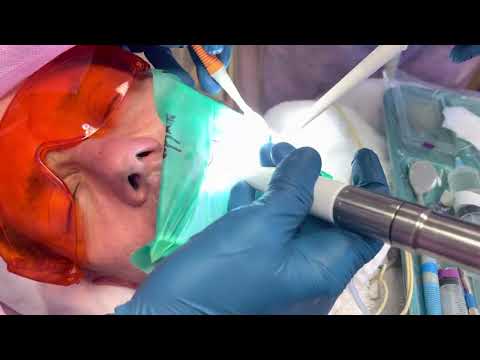 Root Canal Treatment  using the Gentle Wave ! Effective Irrigations