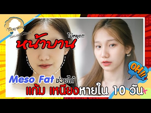 เมโส แฟต