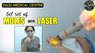 Laser Mole Removal | Get rid of moles with laser | Procedure Video