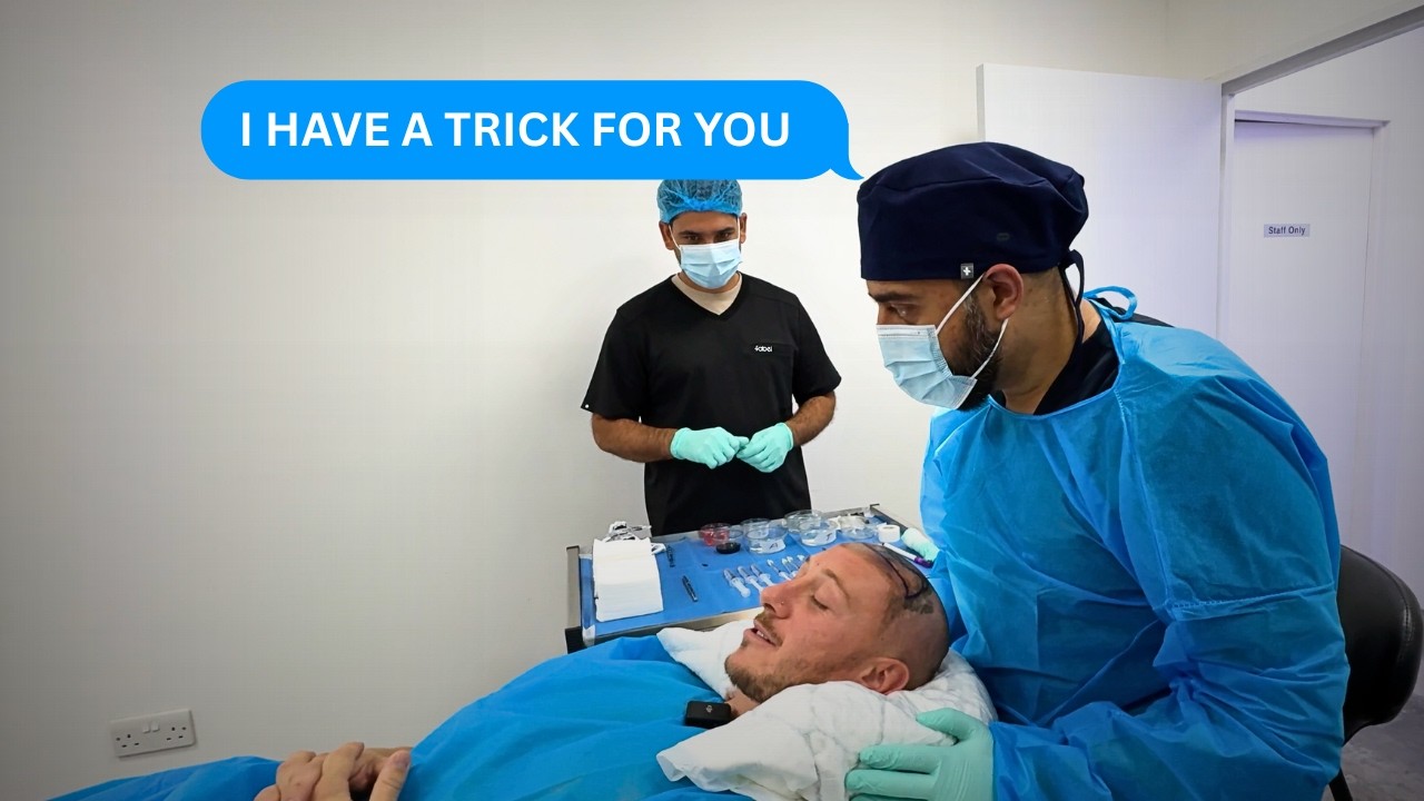 2655 Graft Sapphire FUE Hair Transplant Surgery in London by Dr Shaan
